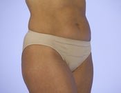 Image of C-Panty Classic Cut Incision Care (Silicone & Support)